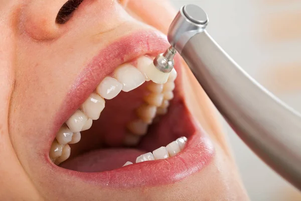 What are the Best Material to used to Polish Teeth?